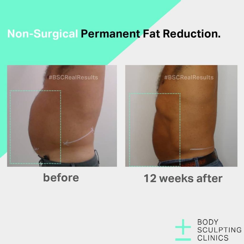 Rejuvenate your body and skin at Body Sculpting Clinics Star Observer