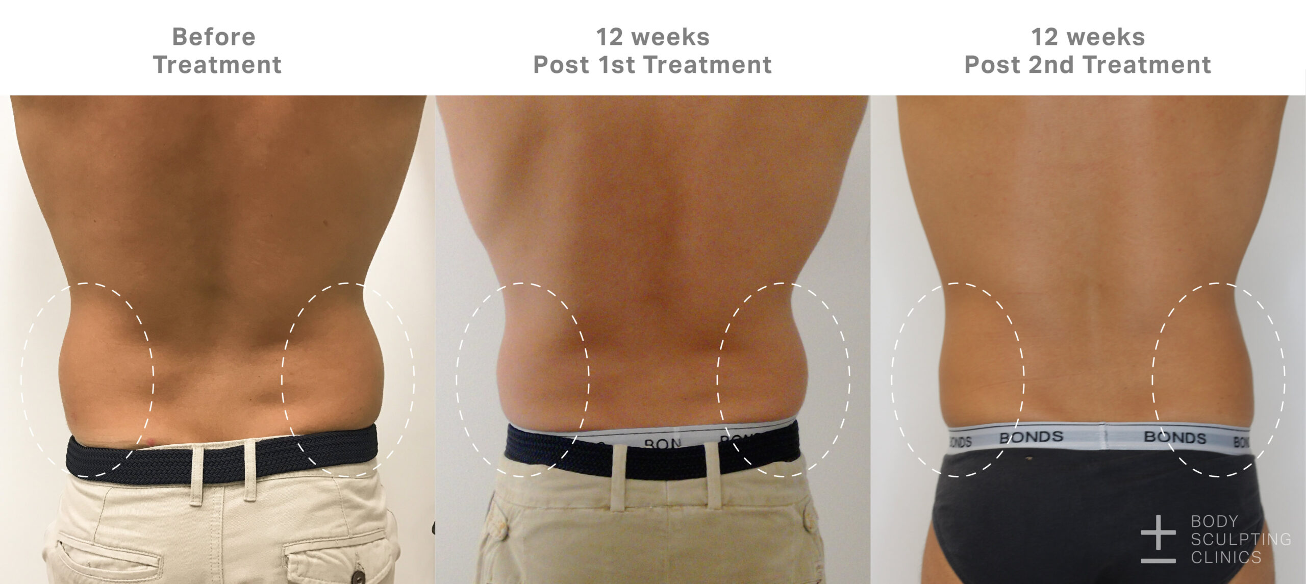 Body Sculpting Clinics will help you build the body you want